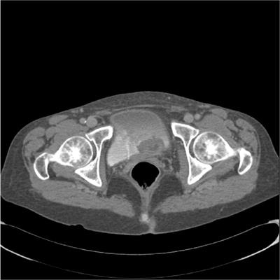 Nodular cutaneous metastasis of the leg in advanced urothelial bladder carcinoma: a case report and systematic literature review